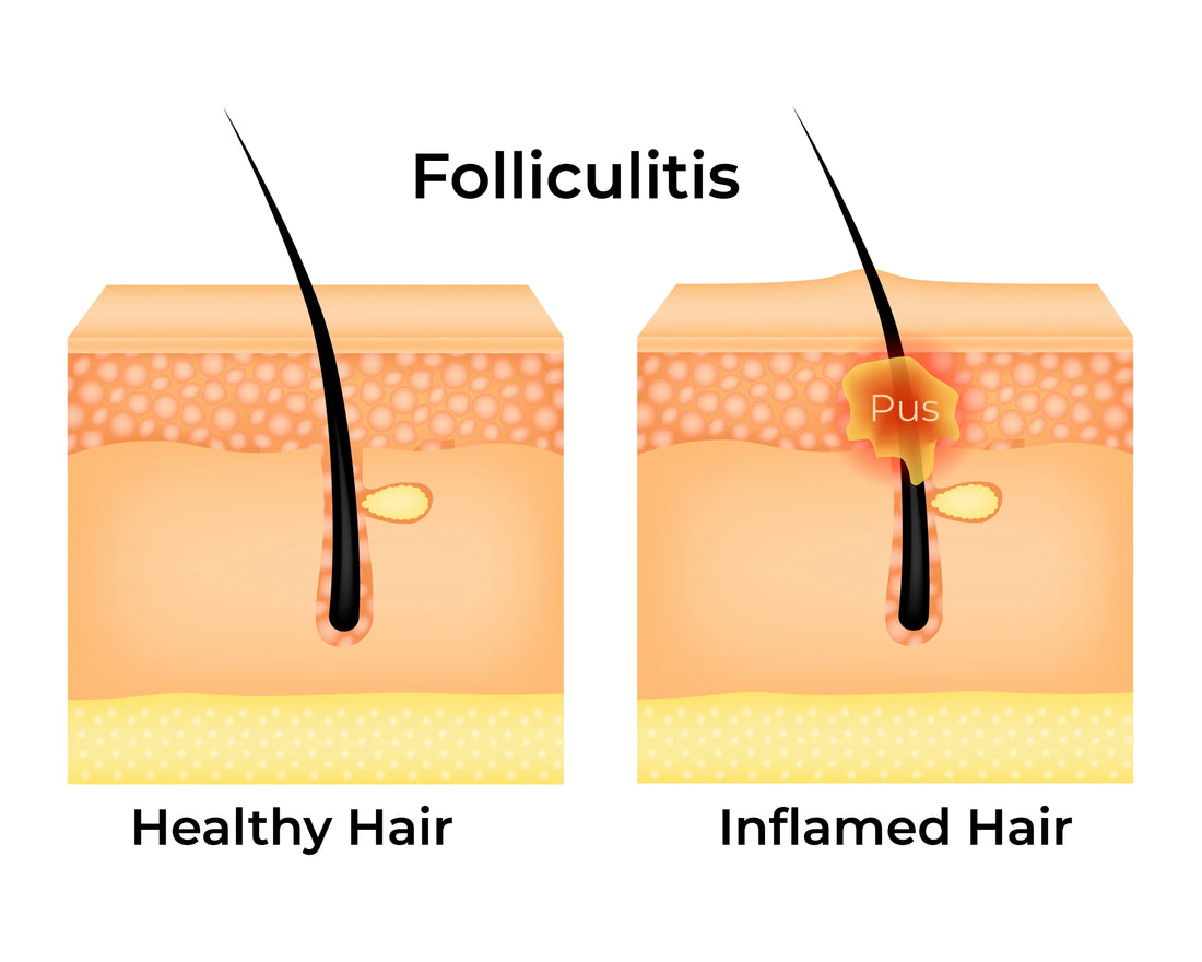 How to prevent and treat bumps after waxing?