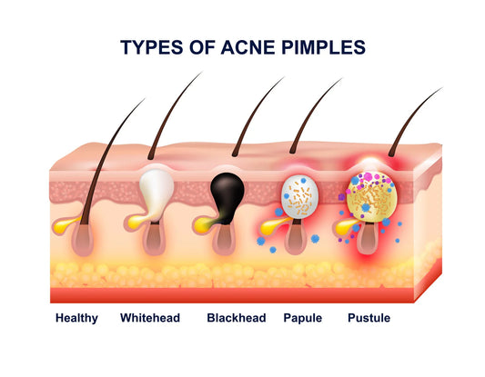 White Bumps After Brazilian Wax: Your Expert Guide to Causes & Solutions